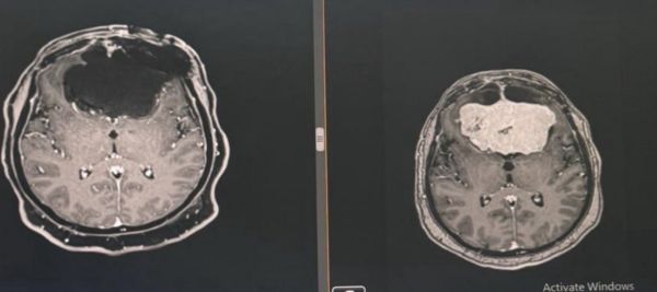 عسير المركزي يُسجل إنجازًا طبياً بإجراء 84 حالة لأورام قاع الجمجمة